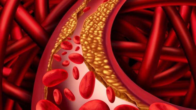 Cual es la causa de la hipertension arterial