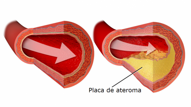 Resultado de imagen para aterosclerosis