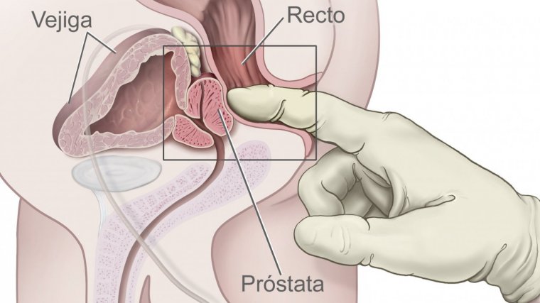 prostata adenomatosa significato