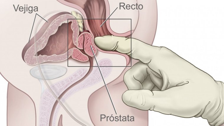 prostatitis nerviosa síntomas