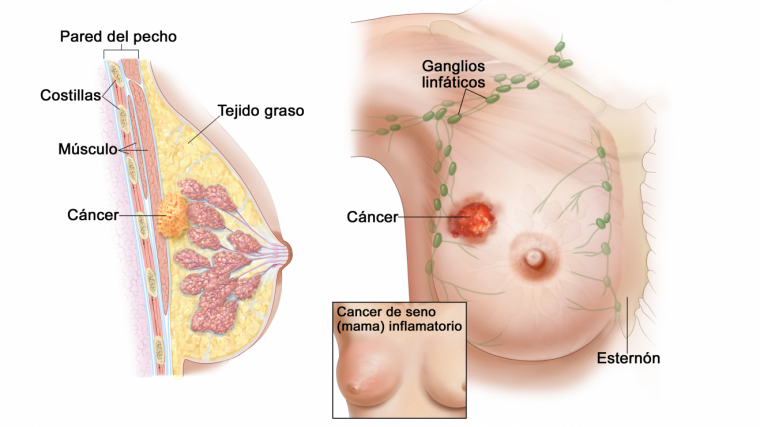 que es cancer de seno cât timp apar viermi după tratament
