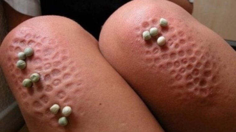 Marcas en los dedos, catalizadores de la tripofobia.