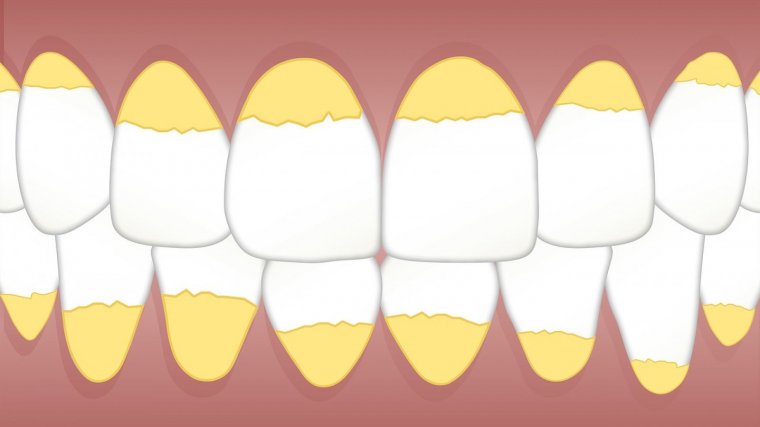 Como eliminar el calculo dental en casa