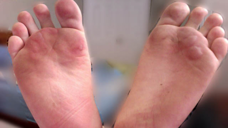 ampollas en los pies curar