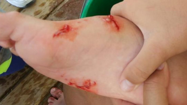 Imatge dels talls que el peix va provocar amb les seves mossegades a un dels nens ferits