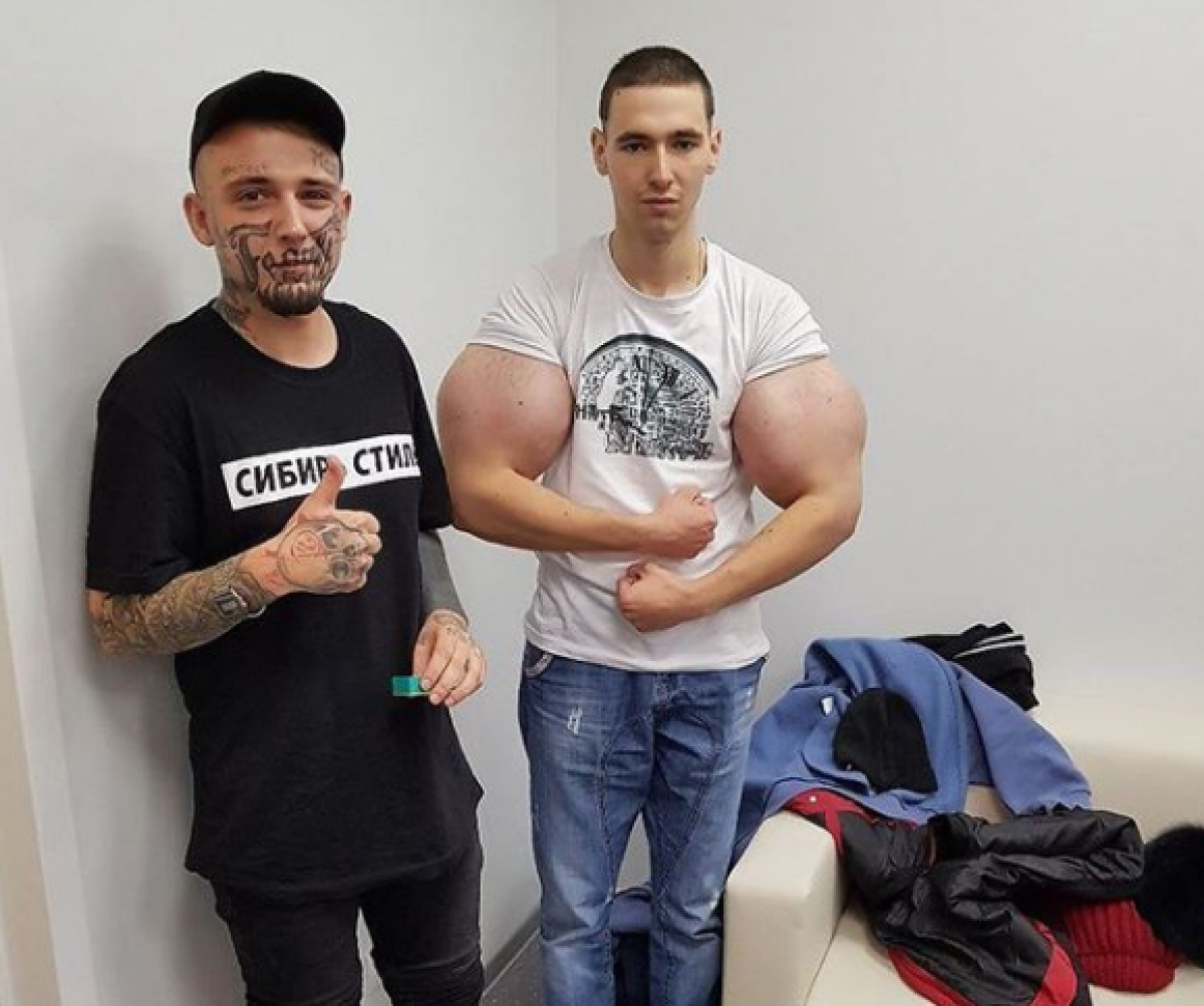 Se inyecta Synthol en sus brazos y ahora podría perderlos