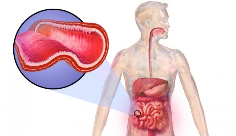 Enfermedad De Crohn Que Es Causas Sintomas Y Tratamiento