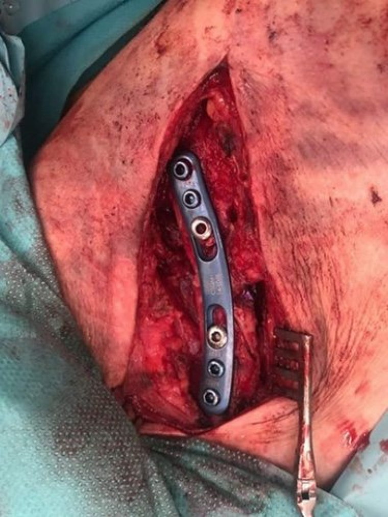 Fotografia de la clavícula de l'aventurer després de la intervenció quirúrgica