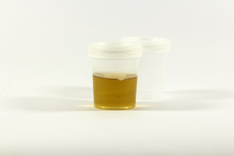 Urine is important to diagnose a urinary tract infection