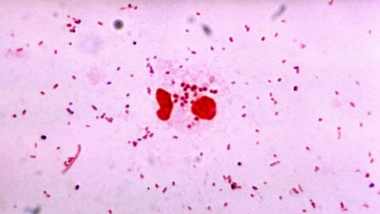 Gonorrea: quÃ© es, sÃ­ntomas, causas y tratamiento de esta ETS