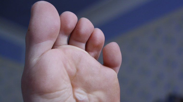 como curar rapido las ampollas de los pies